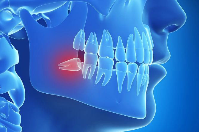 Illustration of an impacted wisdom tooth.
