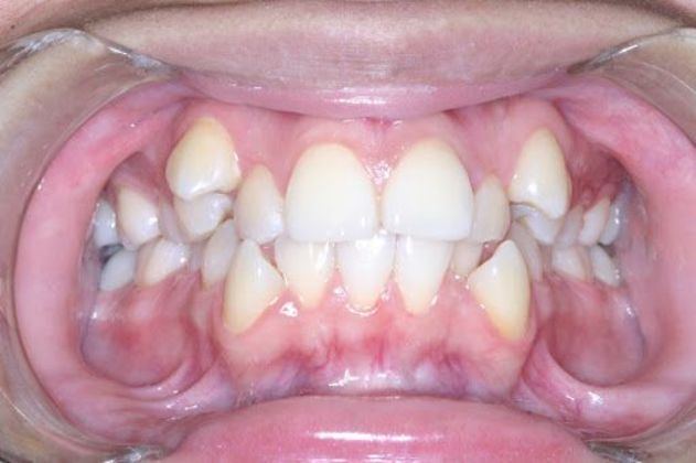 Case 1 before orthodontic procedure